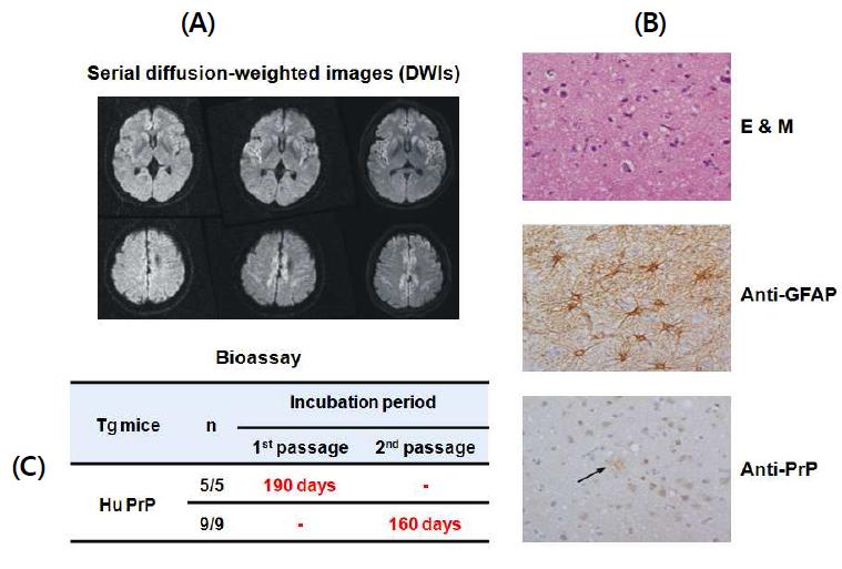 Pathological characterization of brains of iCJD patients. Serial DWIs taken during the course ofdura mater graft-associated iCJD.