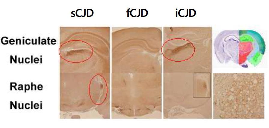 Comparison of PrPSc distribution various CJD Human brain. Histopathologic analysis and immunohistochemistry in sCJD,fCJD and iCJD cases.