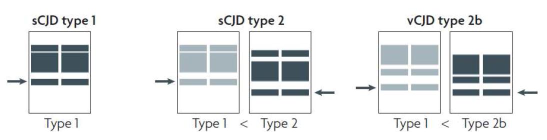 Different PrPSc types in patients with CJD. PrP protein represents 3 of different position bands.