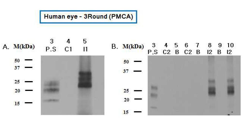 정상인 사람과 환자의 눈곱(eye mucus)을 이용한 조기진단 연구.