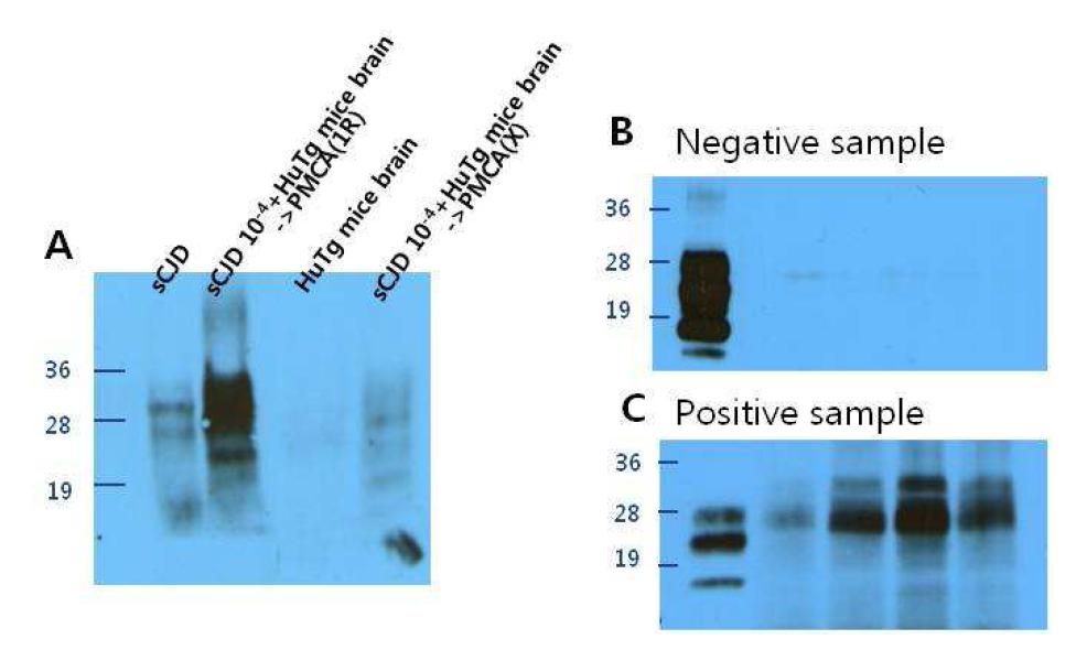 The level of prion protein(PrPSc) in CSF of neurodegenerative diseases