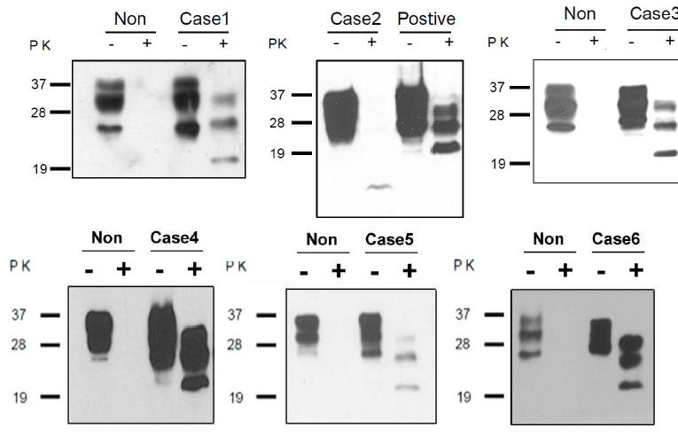 Detection of proteinase K (PK)-resistant PrPSc. Brain homogenates were loaded onto SDS-PAGE, and then transfered to PVDF membrane, then Western blotting was performed using anti-PrP antibody. Non, non-CJD. Positive, PrPSc positive brain.