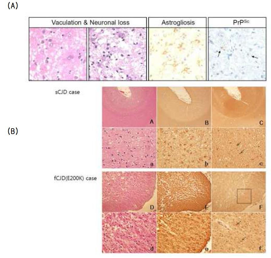 Pathological characterization of brains of sCJD, fCJD patients.