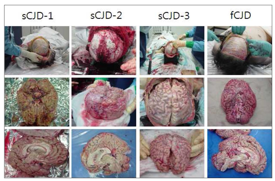 3명의 sCJD 환자 및 1명의 fCJD 환자의 부검샘플