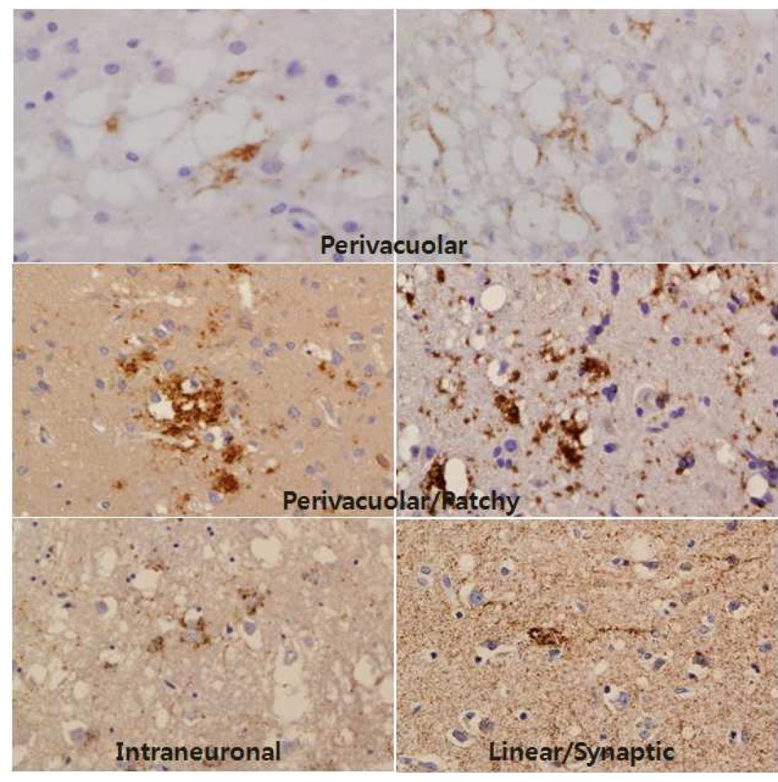 Pattern of disease-associated prion protein in sCJD brain