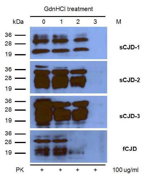 인간 프리온 질환 부검 샘플별 detergent (GdnHCl)에 대한 insolubility.