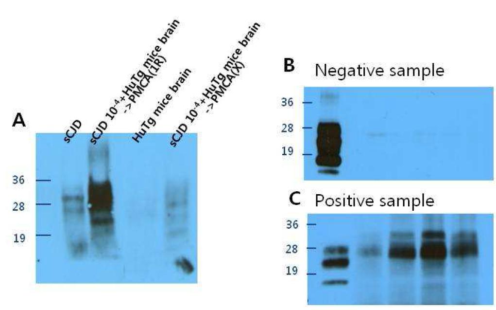 The level of prion protein(PrPSc) in CSF of neurodegenerative diseases