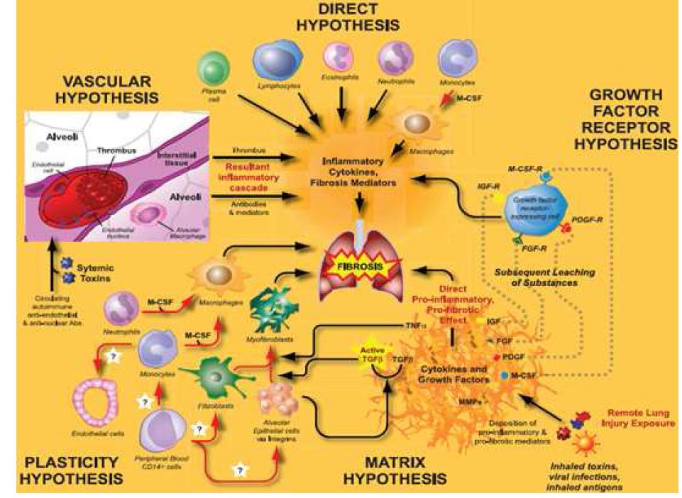 폐섬유증의 병인기전 모델