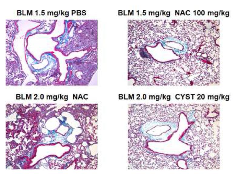 Reduced pulmonary fibrosis through Cysteamine treatment