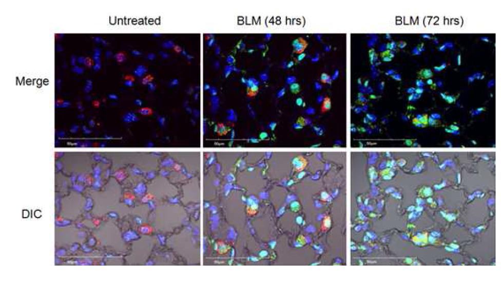 Colocalization of epithelial marker and IL-6 in the pulmonaryepithelial cells following BLM treatment