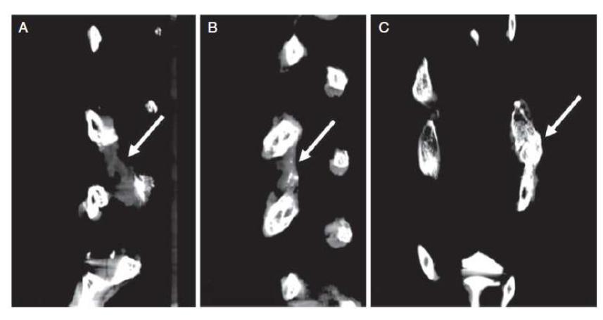 CT 분석 결과 (A) 대조구 그룹 (B) Fibrin-BMP2 그룹 (C) HCF-BMP2 그룹