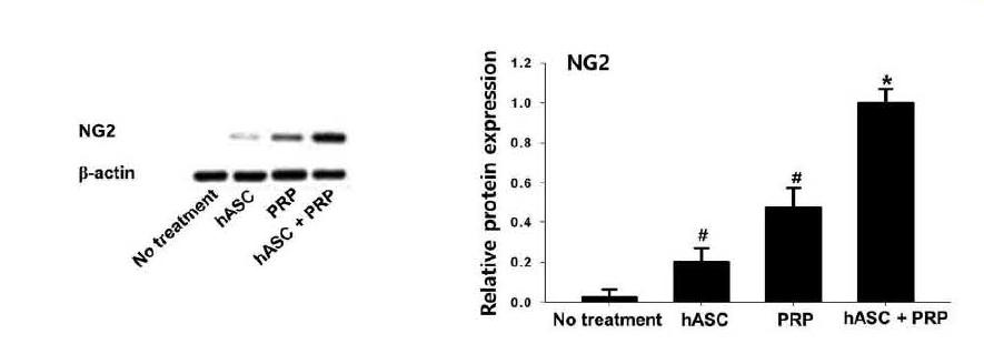 Effect of PRP adlllini stration on angiogenesis 、.Ve st e rn blot analysis and relative protein ex pression 이 NG2 (1’=3) to evalu• ate pericyte Illigration in the wound heali’19 area. #p<O.OS cO Ill I씨 red to no treatment. *p<O.05 compared to other groups