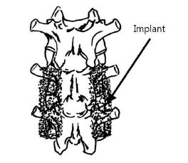 이식물에 의해 생성된 5, 6번 척추 사이의 척추 유합체의 모식도