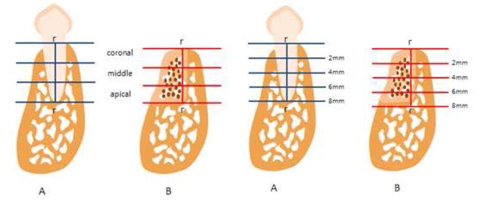 면적 계측 및 협설측 폭경 측정에 대한 모식도. 치조골 폭을 apical, middle 그리고 coronal 의 3개부위 로 나누어 모다 정밀하게 측정하였음.