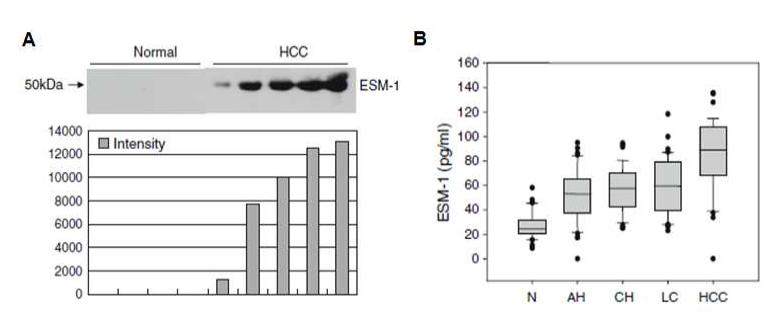 Expression of ESM-1 protein in serum from HCC patients.
