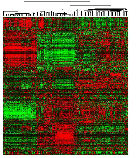 Unsupervised hierarchical clustering of 100 HCC tumors and 40 matched non-tumor liver tissues including 20 noncirrhotic and 20 cirrhotic liver tissues, 20 smaples of metastatic hepatoma from colorectum, 20 samples of cholangiocarcinoma tissues separated the samples into two main groups: T and NT.