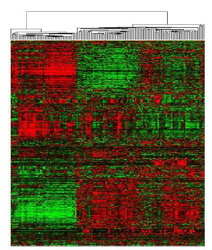 Unsupervised hierarchical clustering of 100 HCC tumors and 40 matched non-tumor liver tissues including 20 noncirrhotic and 20 cirrhotic liver tissues separated the samples into two main groups: T and NT.