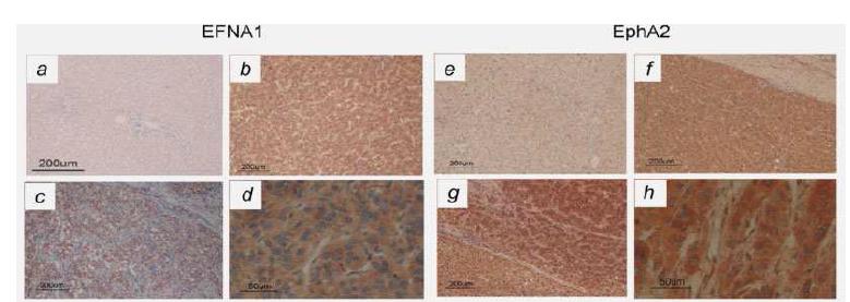 Immunohistochemical detection of EFNA1 and EphA2 in the HCC and non-tumor liver tissues.