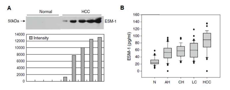 Expression of ESM-1 protein in serum from HCC patients.