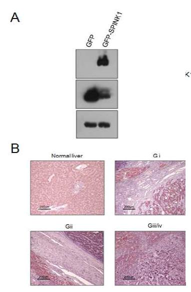 간세포암에서 SPINK1발현