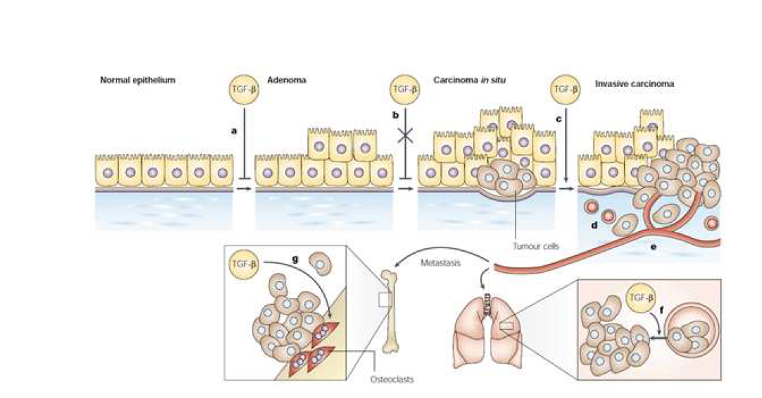 TGFβ에 의한 cancer progression과 metastasis.