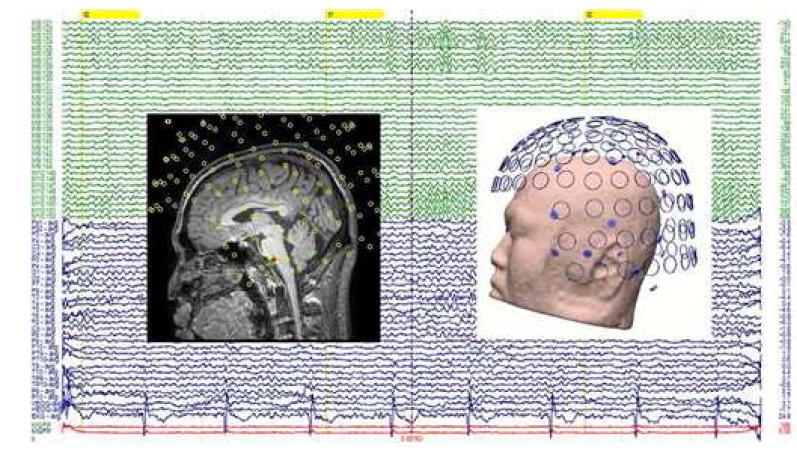 CURRY에서 표시한MEG/EEG 신호 및 센서의 3차원 표시