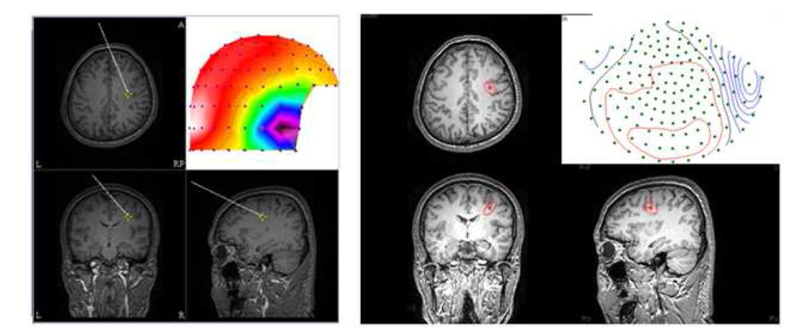 본 연구기관에서 개발한 MRI상에 전류원 표시기술(좌측)과 기존 상용 Curry 상표시기술(우측)의 비교