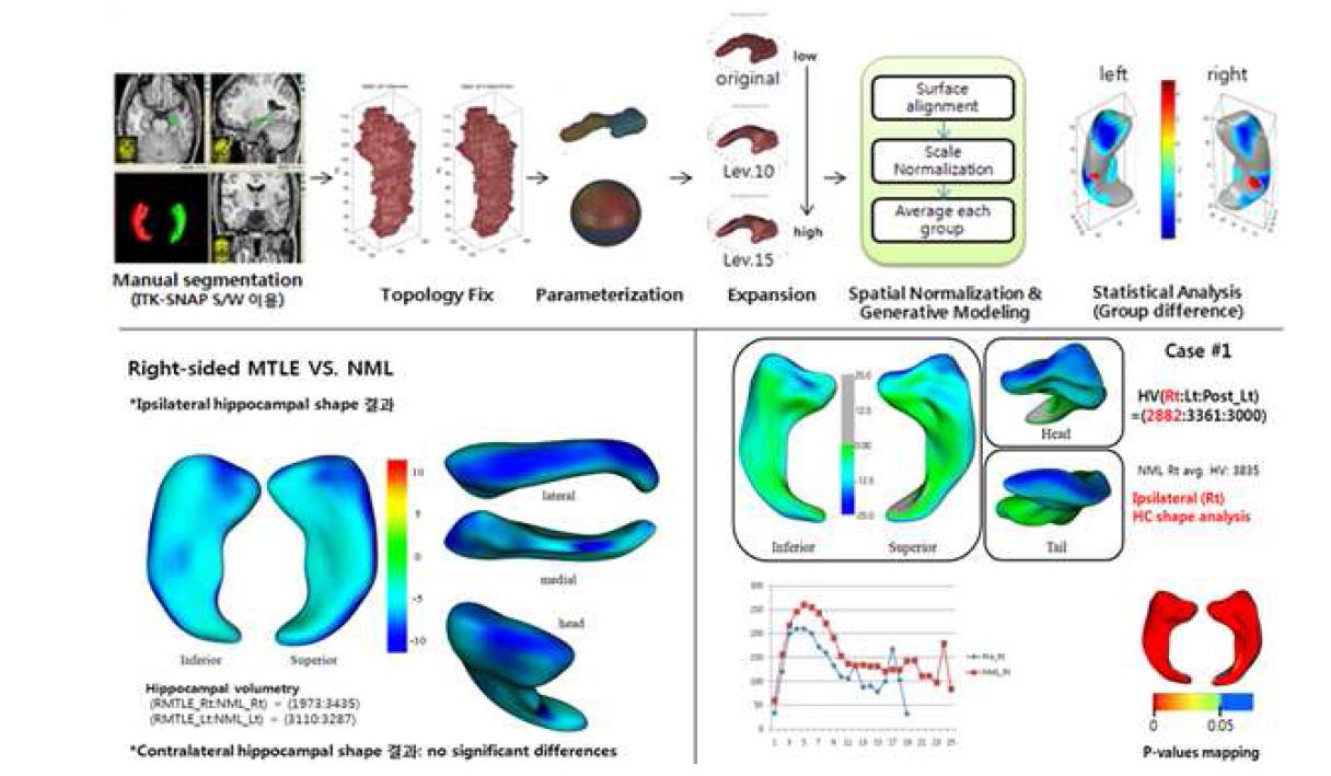 해마 형태 분석법 개발 및 내측두엽 환자군과 개별 비병변성 간질 환자에서의 해마 형태 분석결과 예