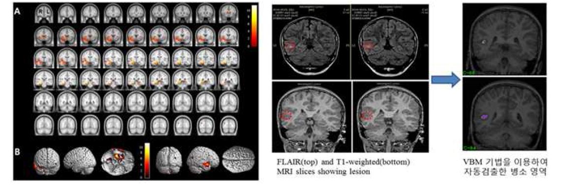 대뇌피질 국소 회색질 농도 분석결과(좌측) 및 대뇌피질 이형성증 이상병변 검색 결과(우측)
