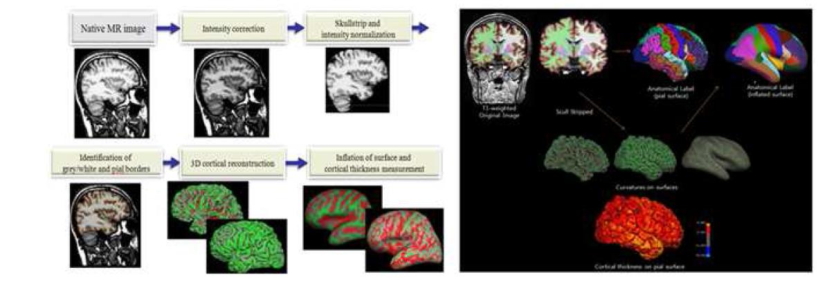 대뇌피질 두께 측정 분석법(좌측)과 개발한 분석법을 이용하여 간질 환자를 대상으로 대뇌피질두께 및 곡률을 분석한 결과(우측)