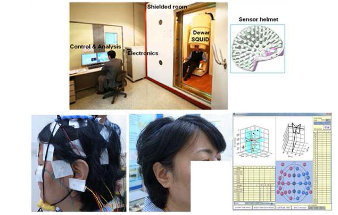 본 그림은 뇌자도 장비 및 환자 뇌자도 기록 모습(상단 좌측), 환자가 머리에 착용하는 sensor helmet (상단 우측), 뇌파 전극 및 마커 코일 부착 모습(하단 좌측), 환자의 머리 위치를 결정하는 landmark 표시 모습(하단 중앙), 마커코일과 환자 landmark간 변환계수 계산 결과(하단 우측)을 나타냄.