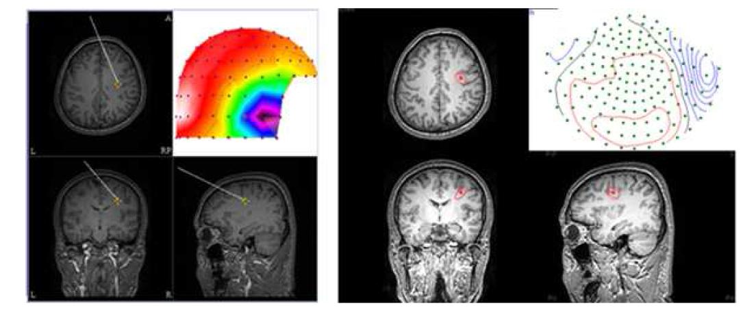 본 연구기관에서 개발한 MRI상에 전류원 표시기술(좌측)과 기존 상용 Curry 상 표시기술(우측)의 비교