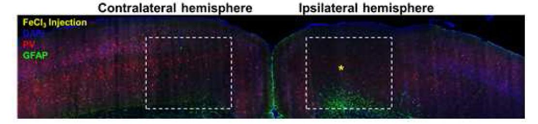 난치성 간질 마우스 모델의 좌우 대뇌 반구에서 억제성 신경세포의 한 종류인 parvalbumin을 발현하는 GABAergic interneuron을 염색한 결과(red), contralateral side에 비하 여 FeCl3 용액을 주입한 ipsilateral side의 대뇌 피질에서만 해당 GABAergic interneuron이 국소 적으로 감소함. GFAP (green) 염색을 통해 교질 세포의 한 종류인 astrocyte의 발현 양상을 본 결 과 (green), FeCl3 용액을 주입한 ipsilateral side에서 astrocyte의 발현이 크게 증가함.
