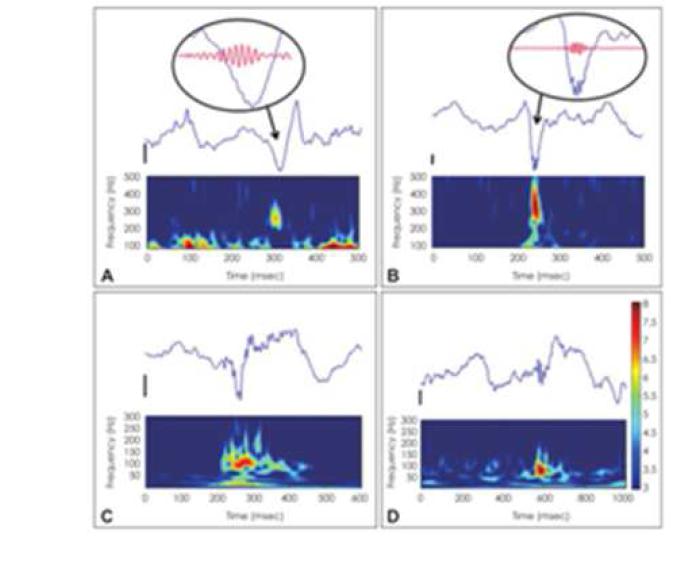 본 연구를 통해 개발한 HFO자동 검출 알고리즘을 이용하여 측두엽 간질 환자들의 피질 뇌파에서 HFO를 분석한 결과: A, C는 ripple, B와 D는 fast ripple임.