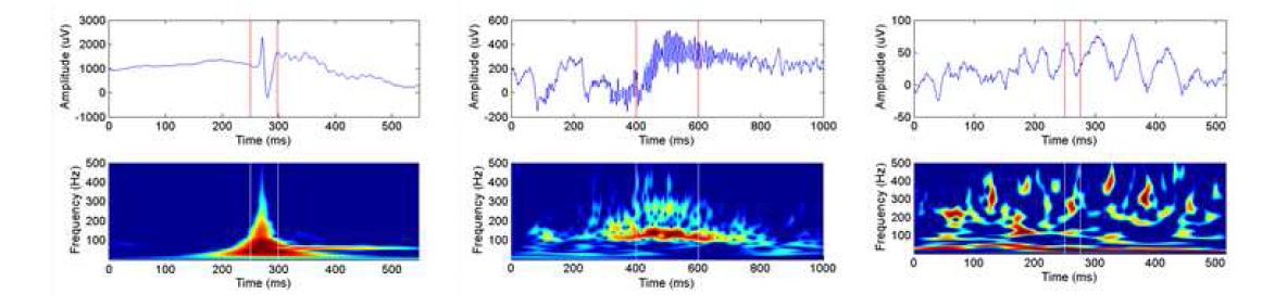 자동화 HFO 검출의 false-positive에 해당하는 주요 세 가지 종류의 신호 패턴
