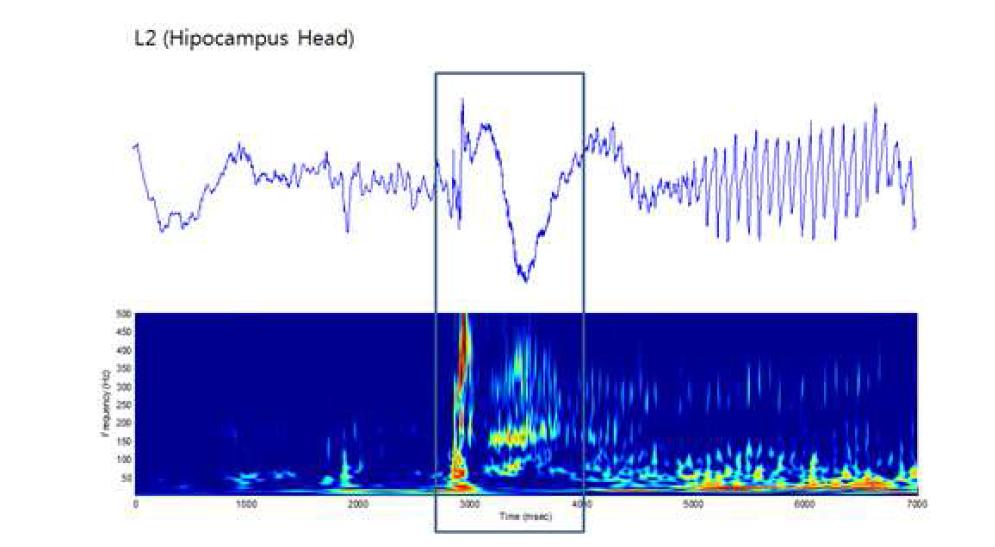 환자 H에서 측정한 Hippocampus head에 삽입된 hybrid macro- micro depth전극에서 Ictal시 측정한 HFO 분석 결과