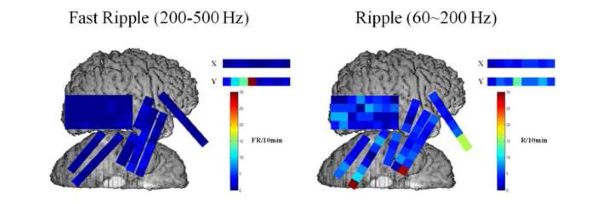 간질 환자에서에서 측정한 발작간기뇌파의 Fast Ripple(왼쪽)과 ripple(오른쪽)