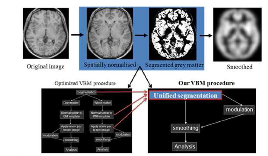 본 연구내용에서 정상군 대비 내측두엽 환자군에서의 뇌 회색질 농도의 국소 변화를 검출하기 위해 사용한 SPM8 기반의 분석 과정
