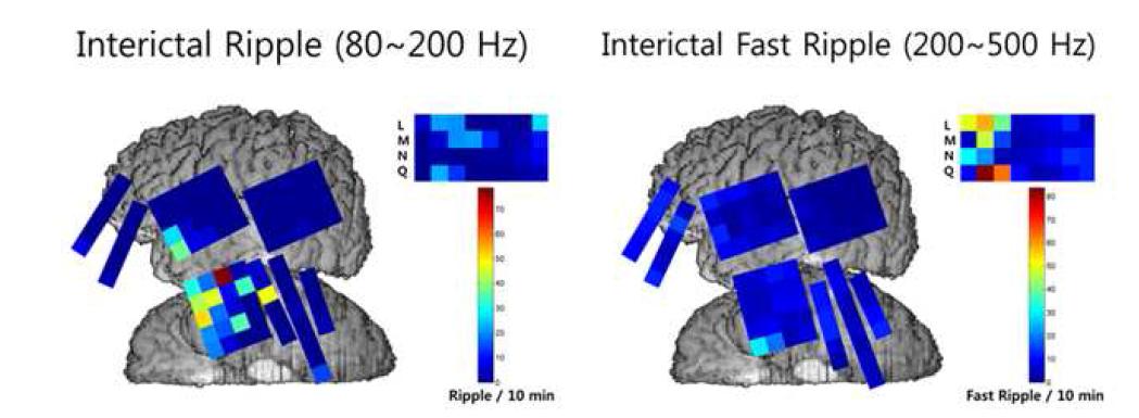Interictal HFO의 brain mapping 가시화 결과 (예시)
