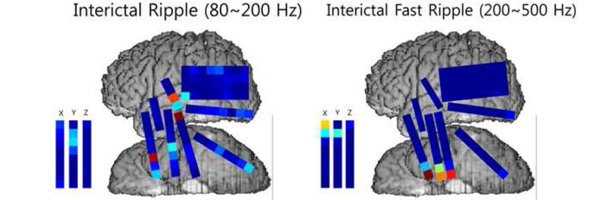환자 18의 두개강내 뇌파에서 분석한 HFO(Ripple과 Fast Ripple) 결과