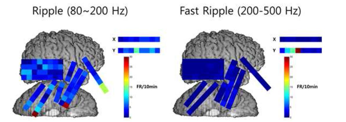 환자 38의 두개강내 뇌파에서 분석한 HFO(Ripple과 Fast Ripple) 결과