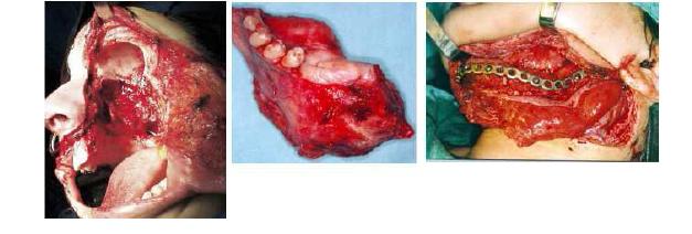 얼굴에 생긴 연조직 및 경조직 육종으로 많은 조직이 결손되고 이에 대 한 재건술이 동반되어야 하는 상황이 발 생됨.