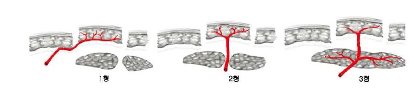 Mathse와 Nahai 의 근육 및 피하 중격 피판 분류로 이 분류는 근육에 공급되는 혈관의 양상을 이 해하고 성공적인 근육피판 을 도안하기 위해 임상적으 로 사용되어 왔음