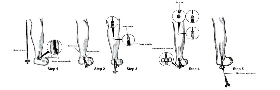 Schematic diagrams showing sural nerve harvesting procedure by use of nerve extractor[ 19] .