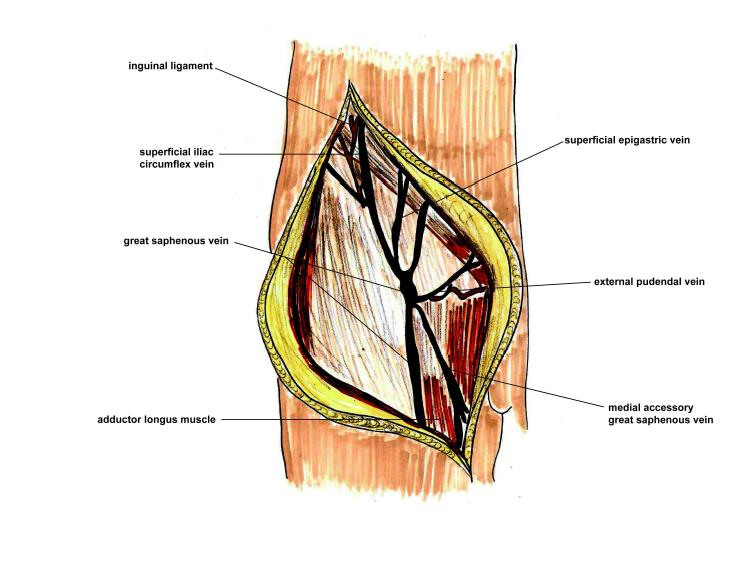 Schematic drawings of epifascial veins including superficial epigastric vein, external pudendal vein, medial accessory great saphenous vein, superficial iliac circumflex vein and great saphenous vein of the inguinal region.