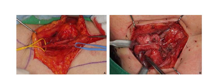 Clinical dissected view showing great saphenous vein with left yellow surgical loop and external pudendal vein with right blue surgical loop (A), and showing microanastomosed interpositional vein graft sites with white asterisks between internal jugular vein and grafted two vena comittans of radial forearm free flap (B).