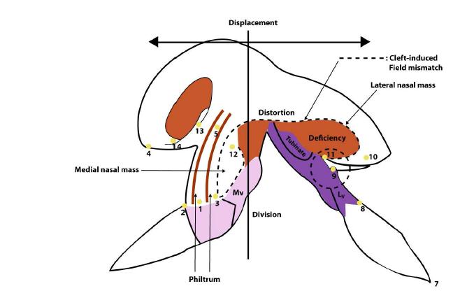 Four- dimensional model of cleft[ 1,3,25] .