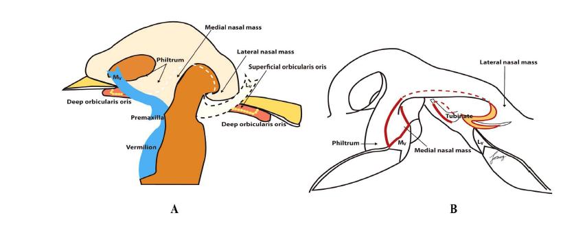 Incision line of the unilateral complete cleft lip, based on the developmental field repair concepts.