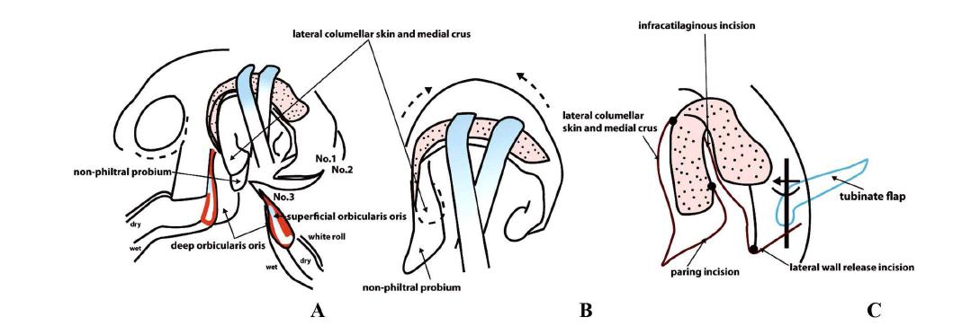 Schematic nasal incision for the advancement of both medial and lateral crura, based on the developmental field repair concepts and Delair's philosophy.