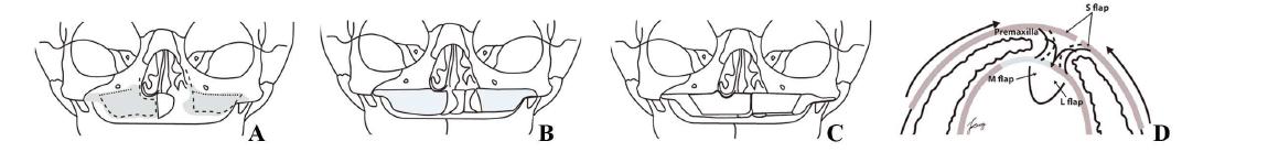 Schematic drawings of double layer periosteoplasty in cleft alveolus, based on the developmental field repair concepts